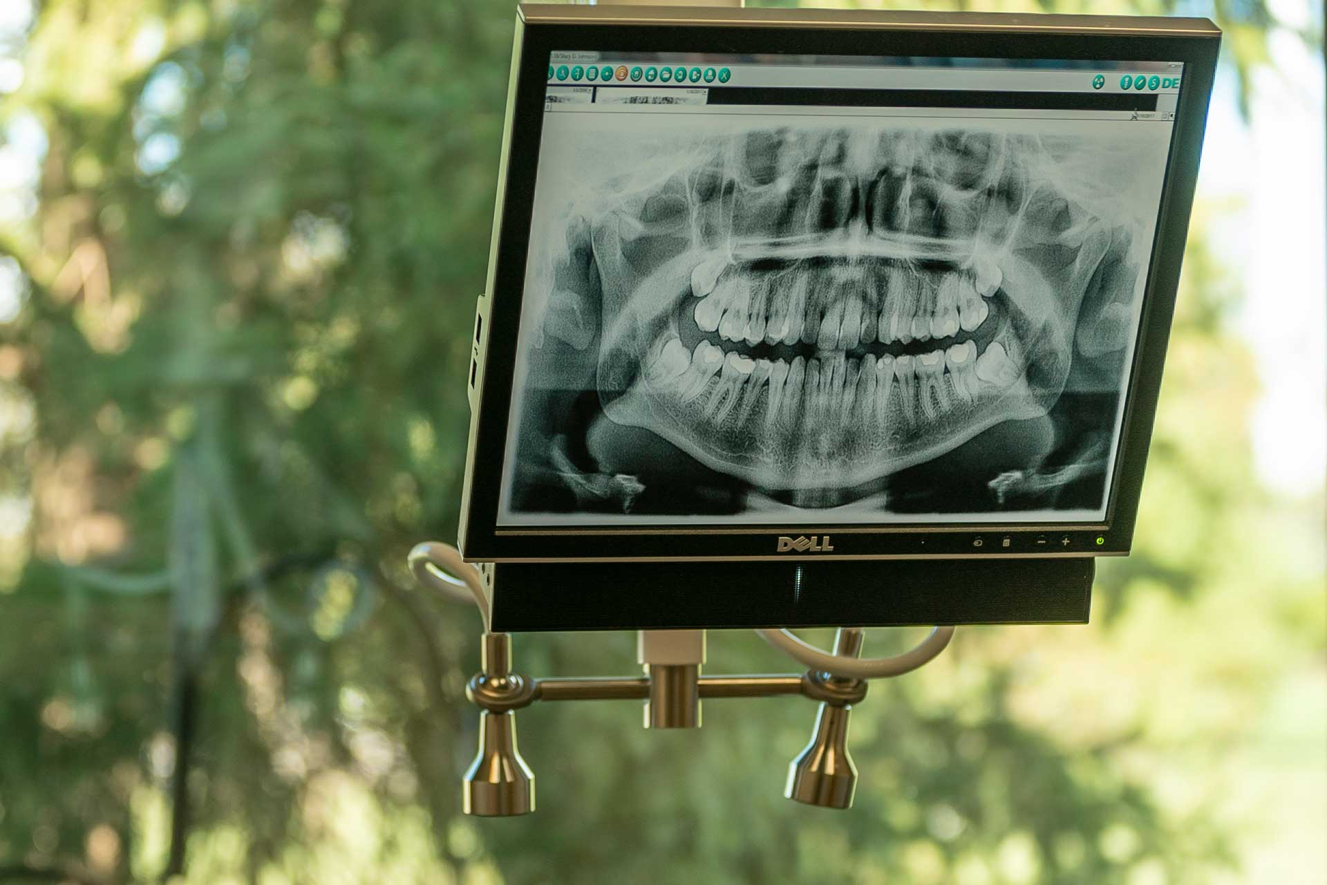computer-display-of-teeth-x-ray