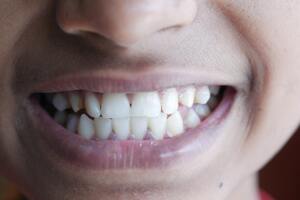 Photo by Towfiqu barbhuiya: https://www.pexels.com/photo/a-close-up-shot-of-a-person-s-teeth-12474261/